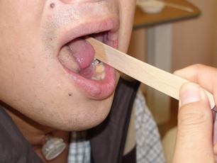 舌がん術後患者さんに対する舌の筋力アップ訓練