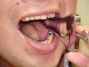 舌がん術後患者さんに対する開口訓練