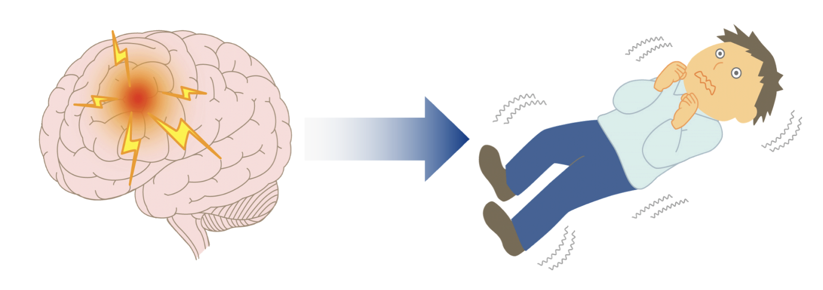 てんかんと熱性けいれんの症状の比較