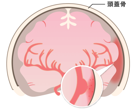 くも膜下出血