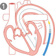 経大腿アプローチの詳細01