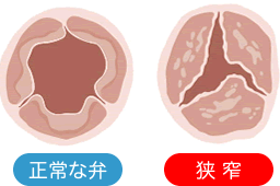 正常な弁と狭窄の図